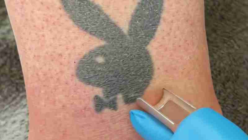 How Laser Tattoo Removal Is Done (@hwclinicbrugge) - Digital concept art for illustrative purpose, tags: een en - Monok